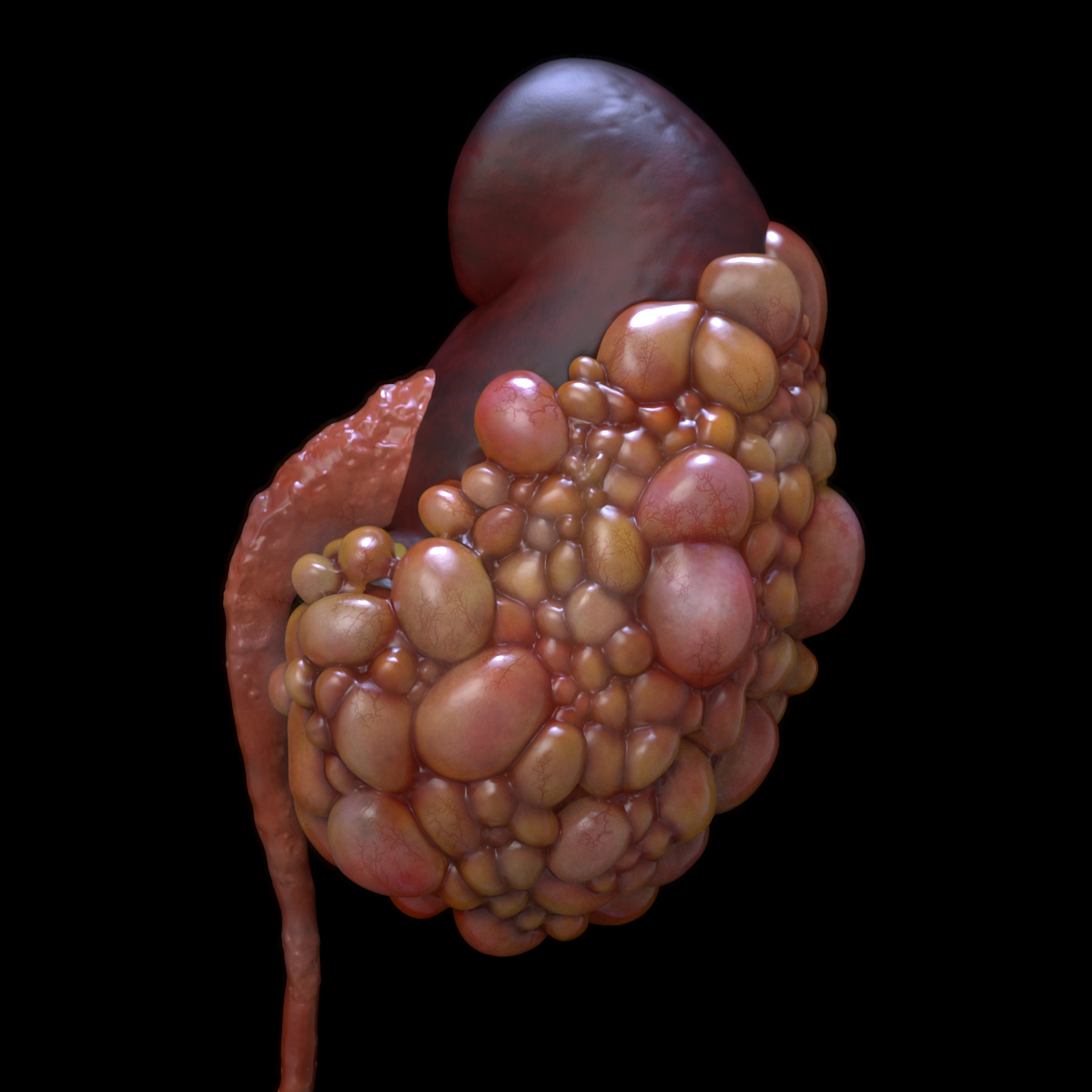 Polycystic%20Kidney%20disease%20