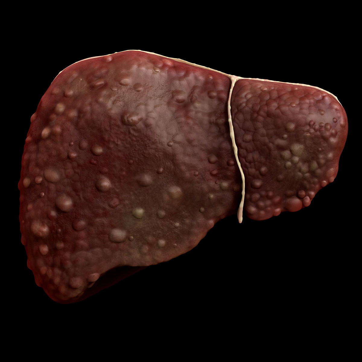 Cirrhosis liver
