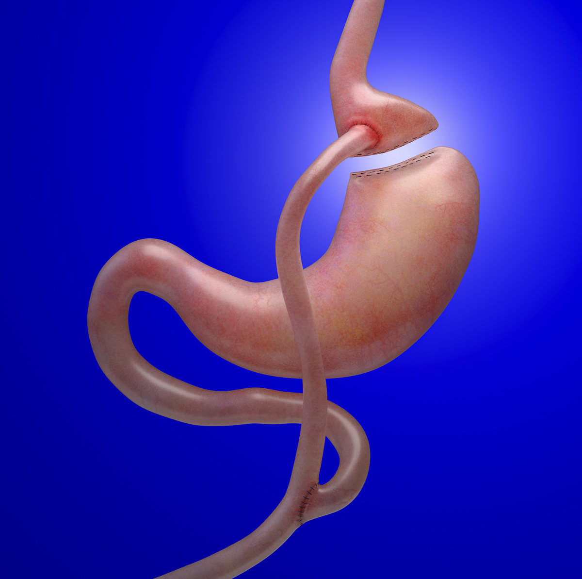Gastric%20Bypass