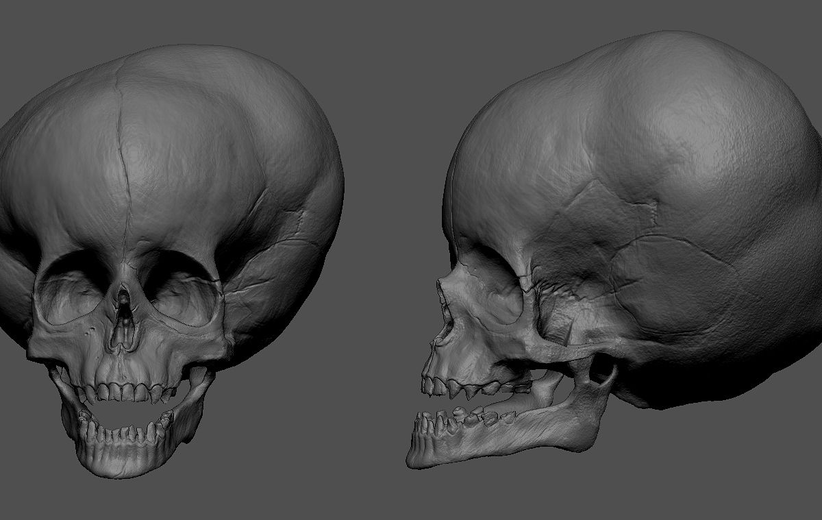 Hydrocephalus_Skull_Zbrush.jpg