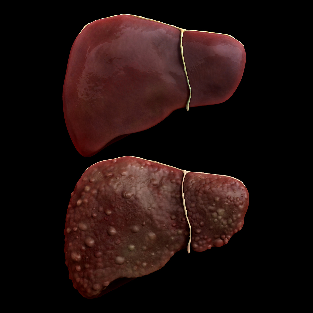 Healthy Liver Compared to  Cirrhotic Liver