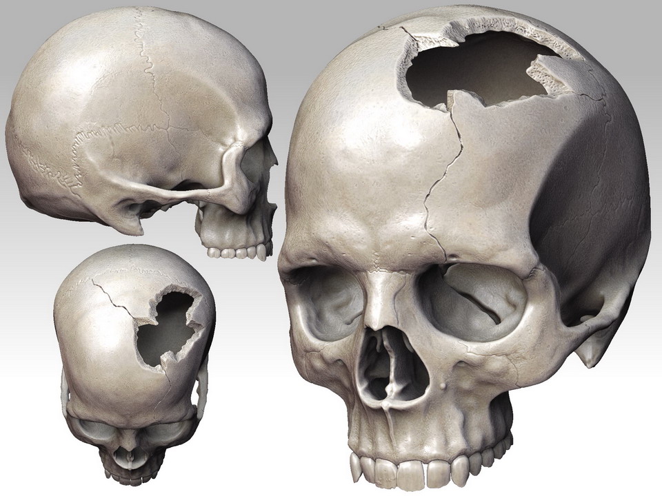 Череп разрыв. Повреждение костей черепа. Дырчатый перелом черепа.