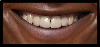 Dents_close_up.jpg
