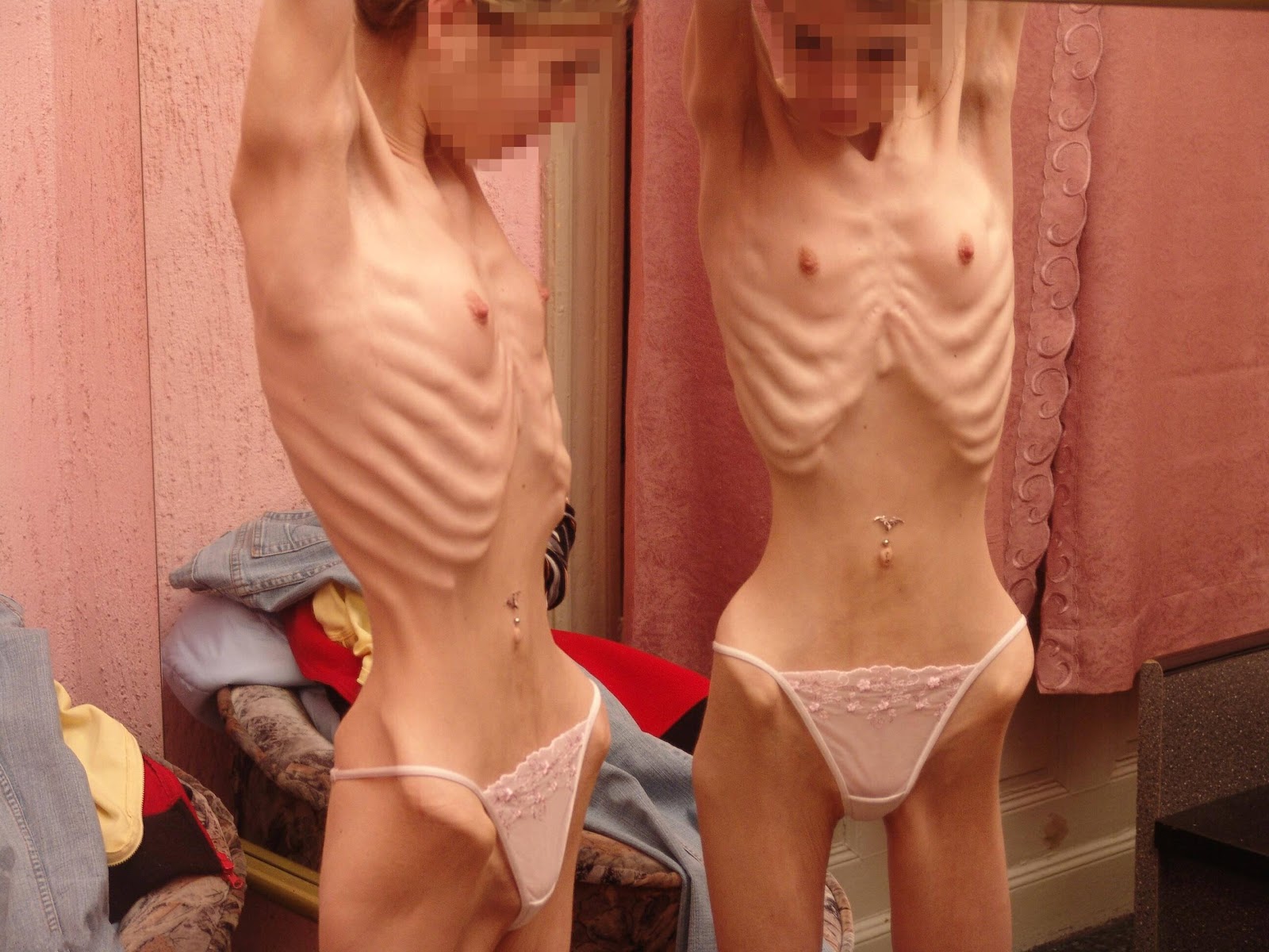 Anorexia nervosa2.jpg