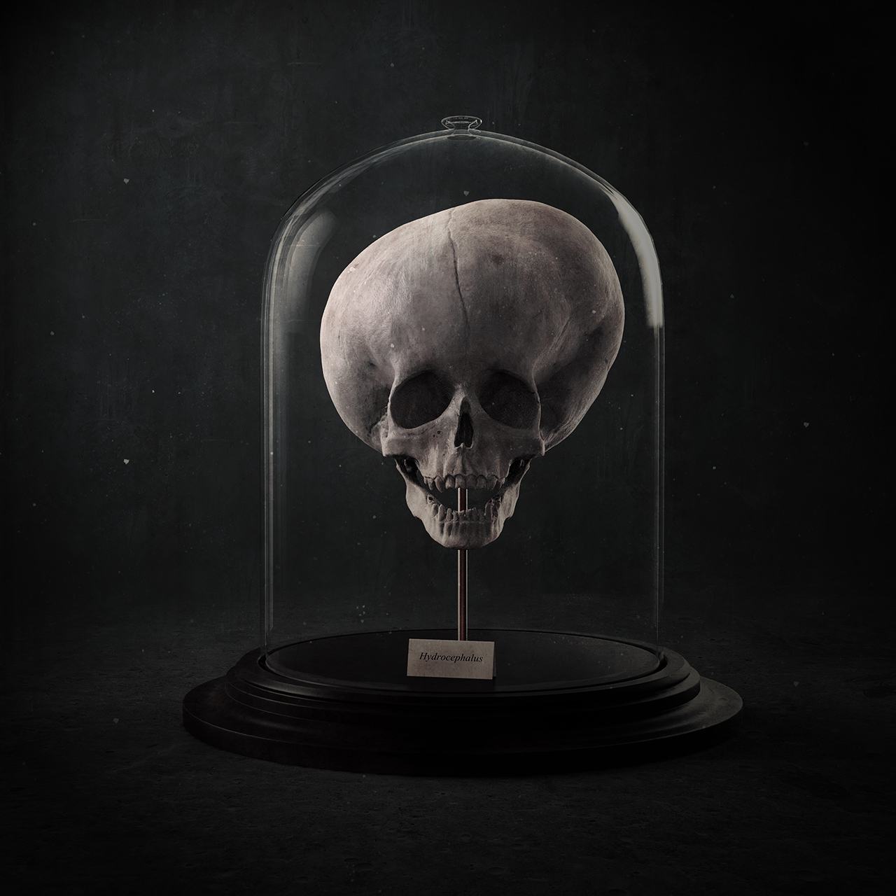 Hydrocephalus-Skull.jpg