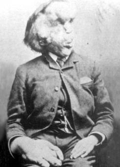 244px-Joseph_Carey_Merrick.JPG