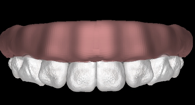 upperteeth.JPG