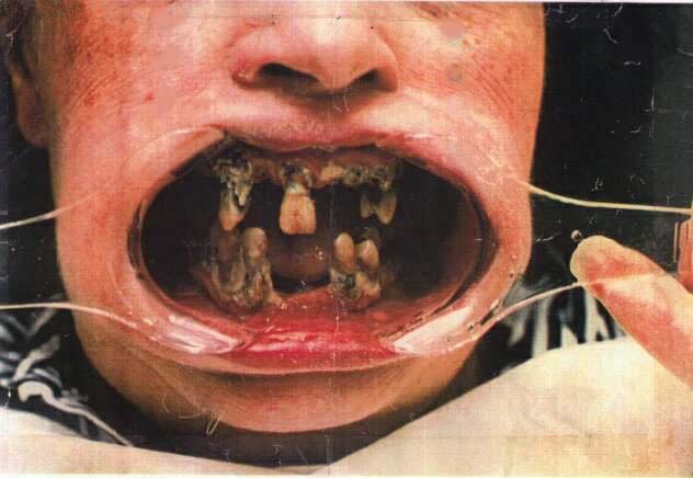 bad_teeth.jpg