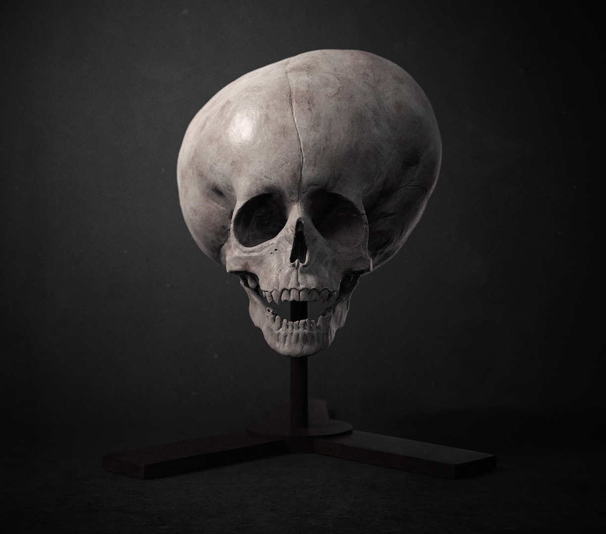 Hydrocephalus_Skull_Render_01.jpg